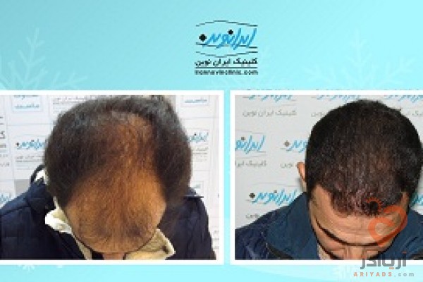 کاشت مو در ایران نوین تنها با دو و نیم میلیون تومان